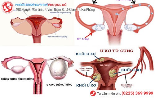 biểu hiện viêm vùng chậu viêm phần phụ