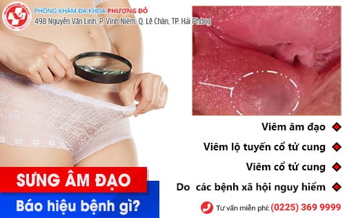 Cảnh giác với hiện tượng sưng âm đạo