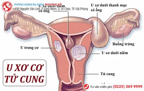 u xơ tử cung gây chảy máu âm đạo bất thường