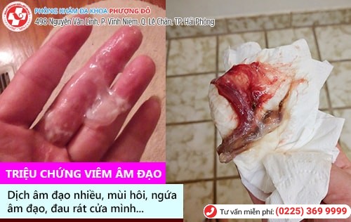 Chia sẻ của bệnh nhân bị viêm âm đạo lâu năm