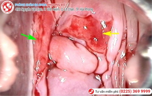 Chia sẻ quý báu về hành trình chữa viêm lộ tuyến cổ tử cung