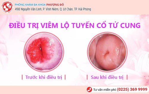 Chia sẻ quý báu về hành trình chữa viêm lộ tuyến cổ tử cung