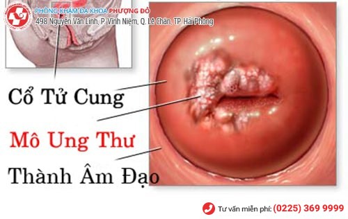 Tổn thương cổ tử cung gây nhiều biến chứng nguy hiểm