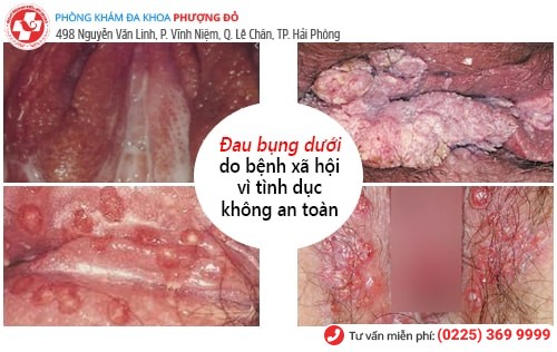 Đau bụng dưới là bị bệnh gì?