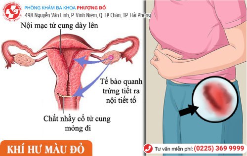 Khí hư màu đỏ là do viêm nội mạc tử cung