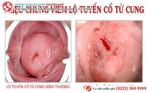 Dấu hiệu viêm lộ tuyến