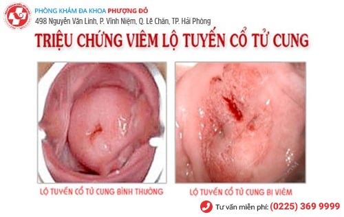 Viêm lộ tuyến cổ tử cung