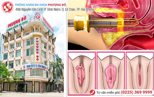 Phượng Đỏ thực hiện nhiều ca thu hẹp vùng kín thành công