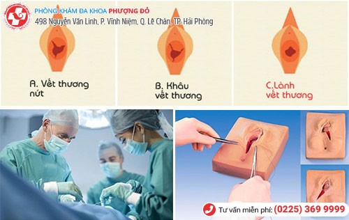 Vá màng trinh tại Phòng Khám Phượng Đỏ