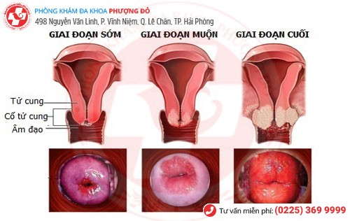 Giai đoạn bệnh viêm lộ tuyến