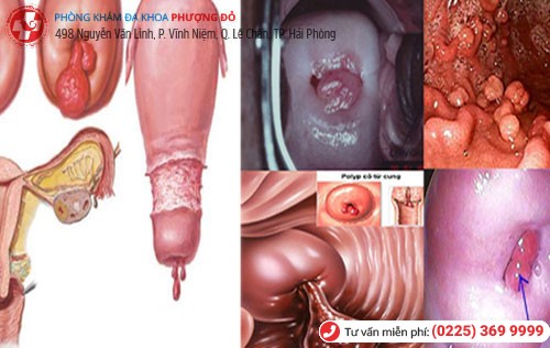 Hình ảnh Polyp cổ tử cung