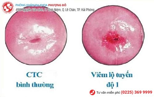 Hình ảnh viêm lộ tuyến cổ tử cung