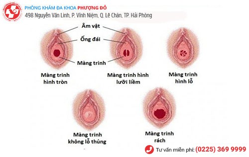 Hình dạng của màng trinh