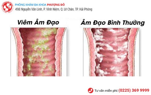 Hiện tượng hôi âm đạo ở nữ giới là dấu hiệu của bệnh gì?