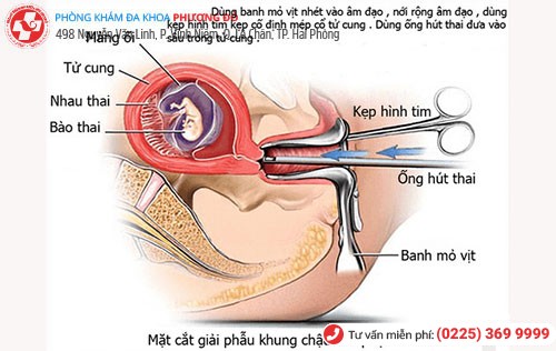 Hút thai chân không cần thực hiện đúng quy trình để đảm bảo sức khỏe thai phụ