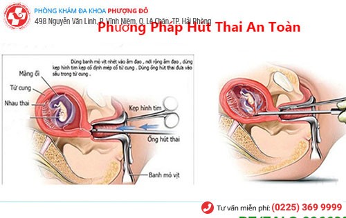 Hút thai - Phương pháp phá thai ngoại khoa an toàn