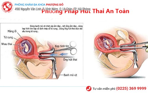 Phương pháp hút thai