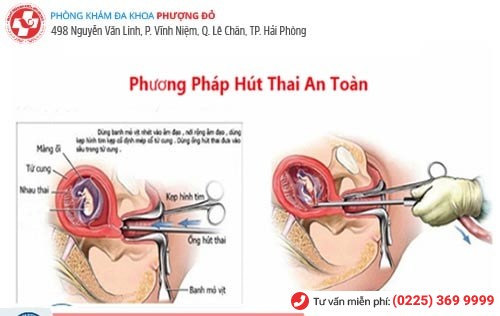 Các phương pháp hút thai an toàn hiện nay