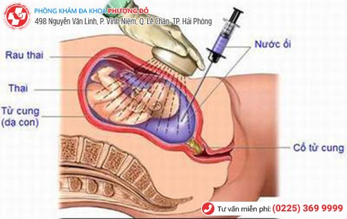 Hút thai bằng chân không