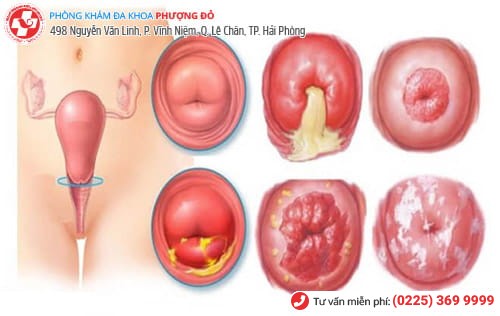 viêm lộ tuyến cổ tử cung