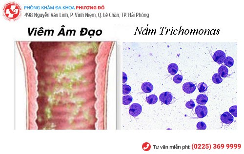 Viêm âm đạo