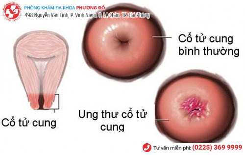 Khí hư màu nâu gây ung thư cổ tử cung 