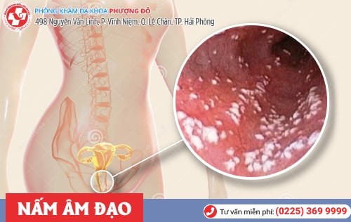 Chia sẻ kinh nghiệm chữa nấm âm đạo