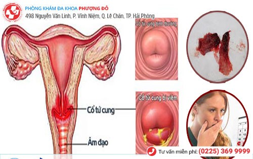 Các bệnh tử cung, cổ tử cung khiến kinh nguyệt có mùi hôi tanh