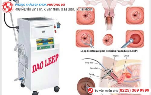 Công nghệ dao LEEP - phương pháp chữa viêm lộ tuyến cổ tử cung tiên tiến nhất hiện nay