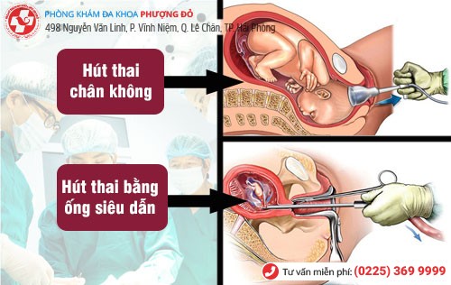 Kỹ thuật hút thai