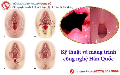 Vá màng trinh công nghệ xâm lấn tối thiểu Hàn Quốc