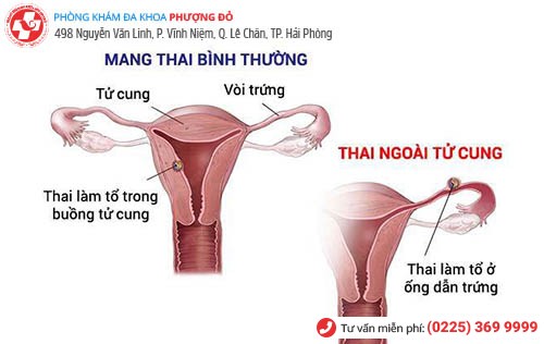 Mang thai ngoài tử cung