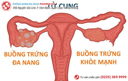 Mất kinh do nguyên nhân nào gây ra?