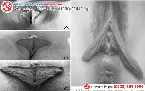 Môi bé thâm đen, phì đại, lão hóa thì nên thu hẹp