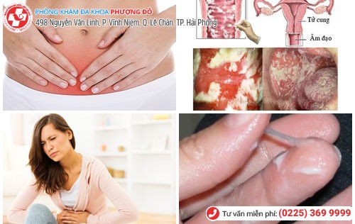 Các triệu chứng cơ bản khi nhiễm nấm 