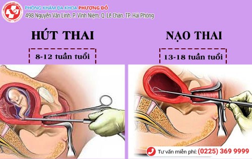 Phương pháp nạo hút thai