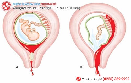 Nguy hiểm ra sao khi bị sót nhau thai?