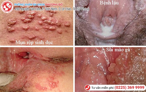 Bệnh qua đường tình dục 