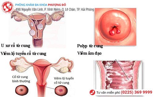 Nguyên nhân khí hư màu trắng