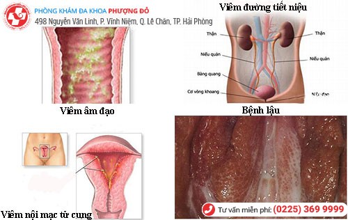 Nguyên nhân tiểu buốt nữ