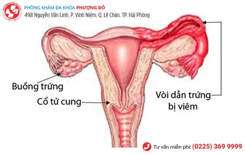 Nguyên nhân viêm vòi trứng