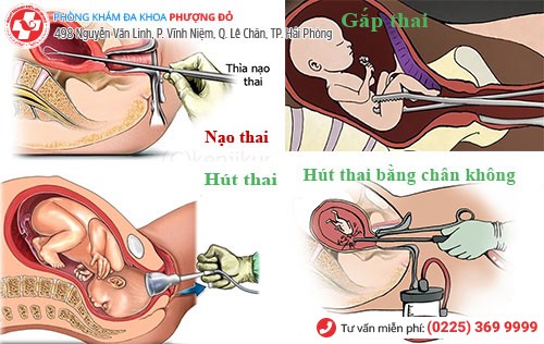 Các phương pháp phá thai