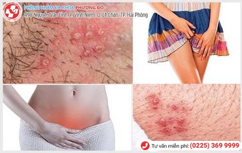 Nổi mụn cửa mình là dấu hiệu nhiều bệnh nguy hiểm