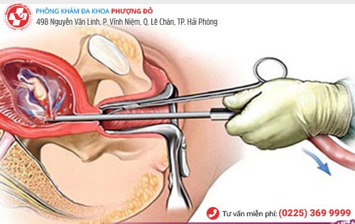 Nong và gắp thai - phương pháp phá thai lớn hiệu quả