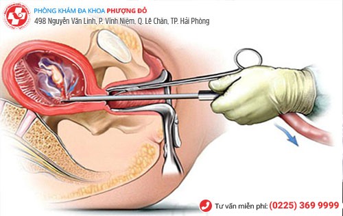 Phương pháp hút thai