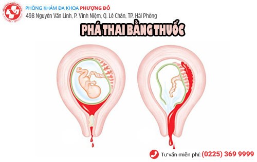 Các loại thuốc phá thai sử dụng khi nào