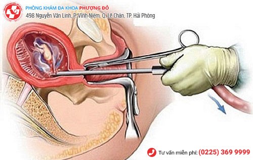 Phá thai không an toàn sẽ đê lại sẹo ở tử cung