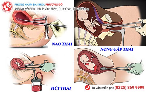 1 số phương pháp phá thai theo tuần hiệu quả hiện nay