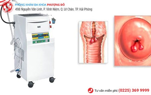 Công nghệ dao LEEP - cách điều trị Polyp cổ tử cung hiệu quả