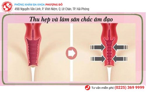 Thẩm mỹ âm đạo